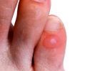 Blisters-150x150