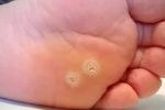 Callus-formation-1-150x150