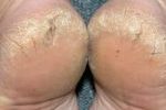 Cracked-heel-150x150