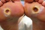 Diabetic-foot-ulcers-150x150