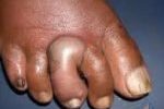Foot-Abscess-150x150