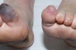 Foot-Gangrene-150x150