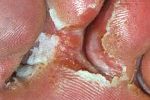 Fungal-infection-150x150